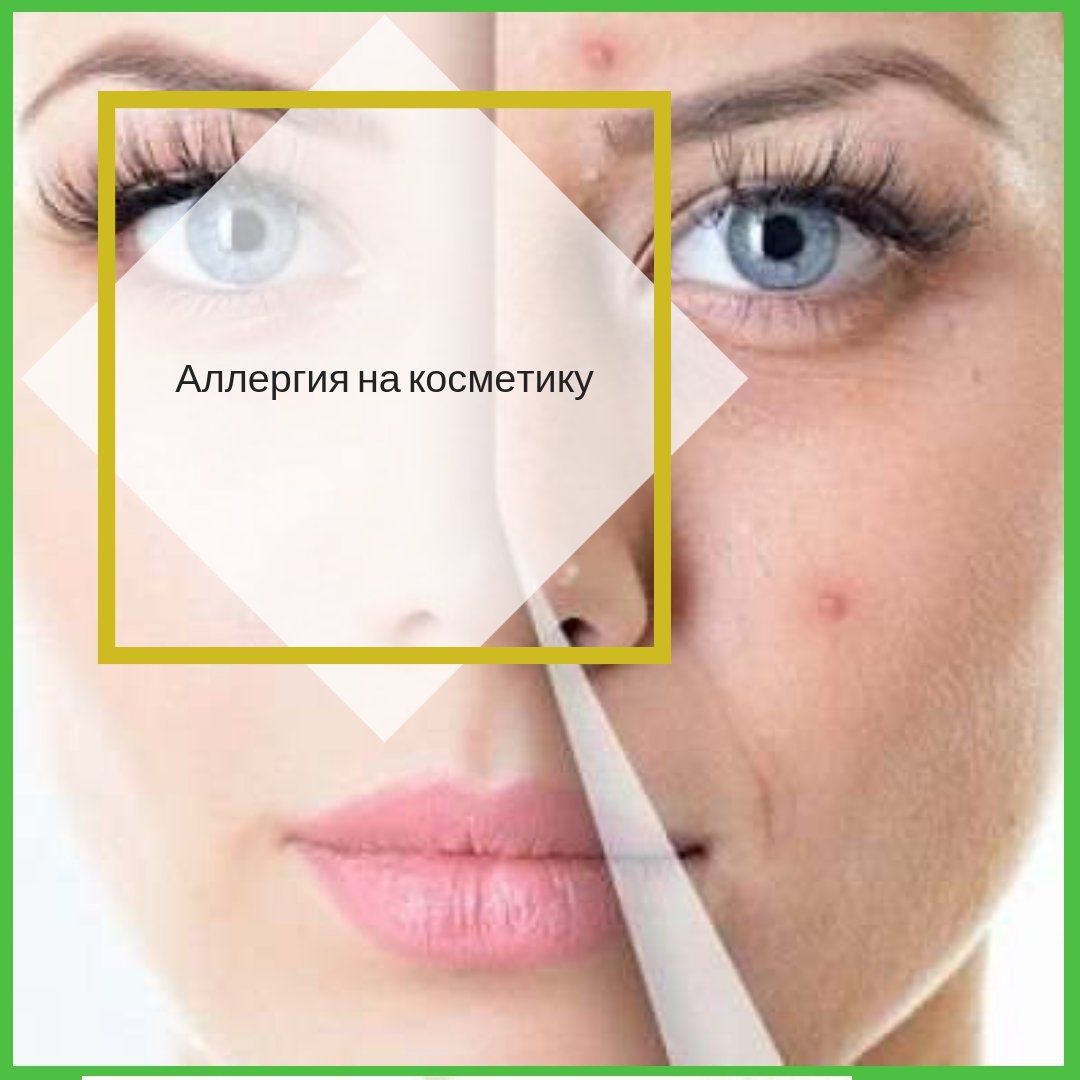 Аллергия