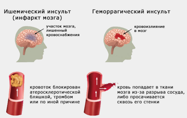 Различия ишемического и геморрагического инсульта