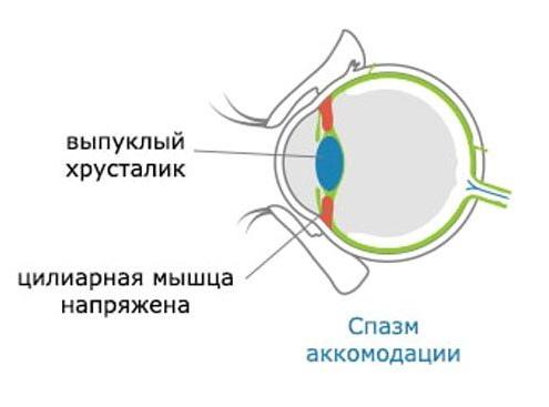 Спазм аккомодации &mdash; лечение и причины