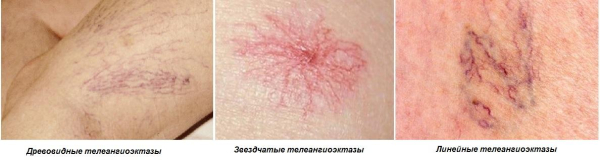 Телеангиэктазия &mdash; причины, лечение, удаление