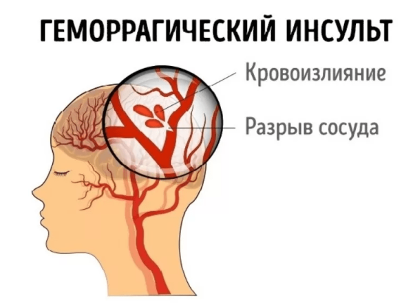Различия ишемического и геморрагического инсульта