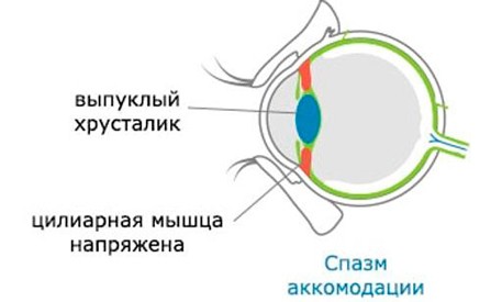Спазм аккомодации &mdash; лечение и причины