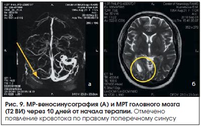 Тромбоз синуса головного мозга &mdash; причины, симптомы и лечение