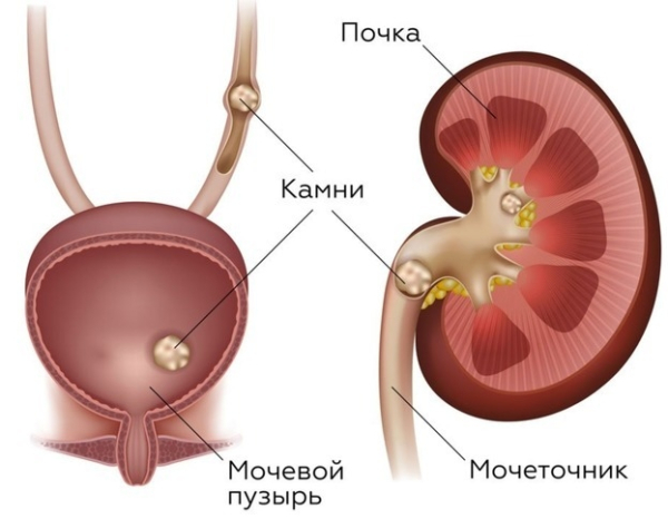 Болезни почек — особенности у женщин Болезни почек — особенности у женщин