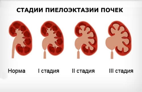 Особенности развития пиелоэктазии почек Особенности развития пиелоэктазии почек