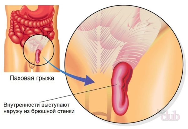 Операция удаления паховой грыжи для мужчин, женщин и детей