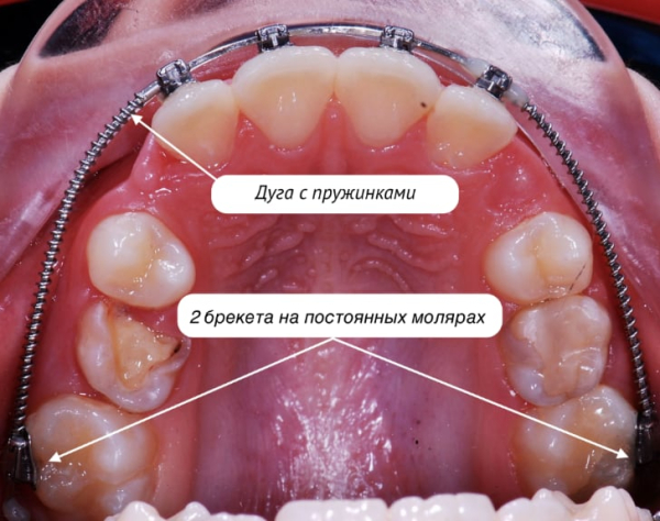 Возрастные ограничения для ношения брекет-систем Возрастные ограничения для ношения брекет-систем