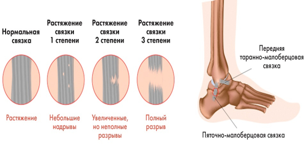 Растяжение связок стопы &mdash; лечение, причины, симптомы, что делать