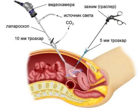 После удаления матки &mdash; что делать со спайками?
