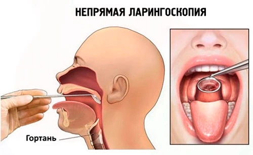 Рак гортани &mdash; симптомы и первые признаки