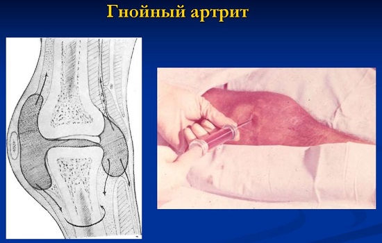 Гнойный артрит колена и голеностопа — симптомы и лечение Гнойный артрит колена и голеностопа — симптомы и лечение