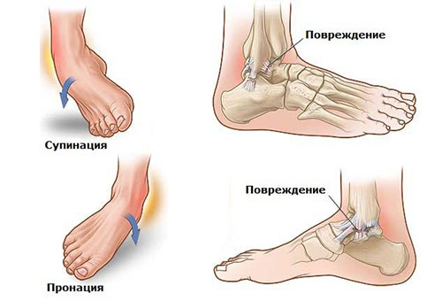 Растяжение связок стопы &mdash; лечение, причины, симптомы, что делать
