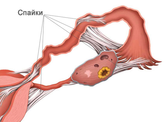 После удаления матки &mdash; что делать со спайками?