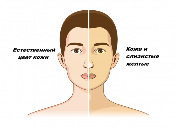 Желтуха — причины, симптомы, лечение у детей и взрослых Желтуха — причины, симптомы, лечение у детей и взрослых