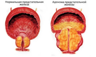 ДГПЖ 1 степени &mdash; причины, симптомы, лечение