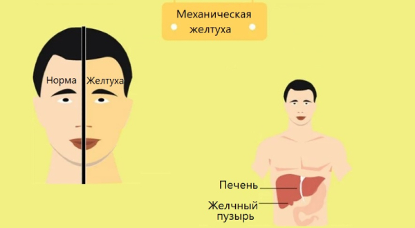 Желтуха — причины, симптомы, лечение у детей и взрослых Желтуха — причины, симптомы, лечение у детей и взрослых