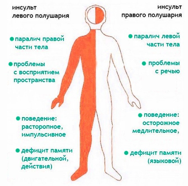 Различия ишемического и геморрагического инсульта