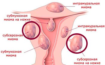 Подслизистая миома матки &mdash; симптомы, диагностика и лечение