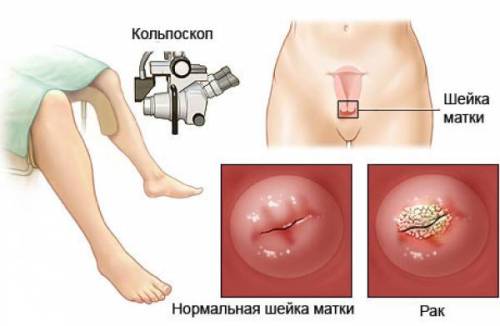 Первые симптомы рака шейки матки у женщин Первые симптомы рака шейки матки у женщин