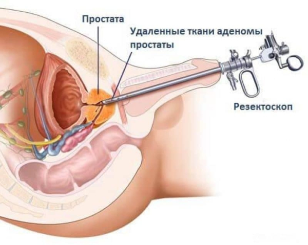 ДГПЖ 1 степени &mdash; причины, симптомы, лечение