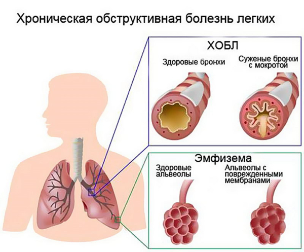 Почему болят легкие после курения и как справиться с этим