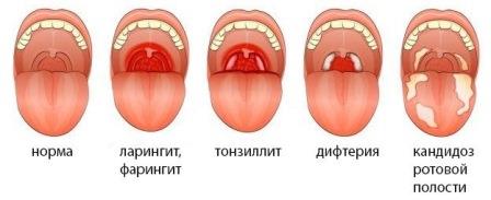 Ларинготрахеит у детей &mdash; симптомы, лечение, виды