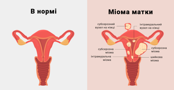 Подслизистая миома матки &mdash; симптомы, диагностика и лечение