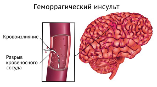Геморрагический инсульт — симптомы, лечение, последствия Геморрагический инсульт — симптомы, лечение, последствия