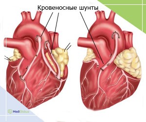 Коронарное шунтирование — операция и последствия Коронарное шунтирование — операция и последствия