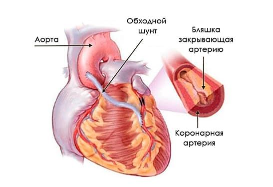 Коронарное шунтирование — операция и последствия Коронарное шунтирование — операция и последствия
