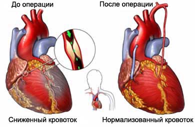 Коронарное шунтирование — операция и последствия Коронарное шунтирование — операция и последствия