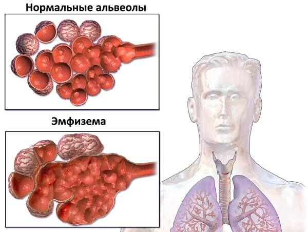 Что будет, если не лечить бронхит Что будет, если не лечить бронхит