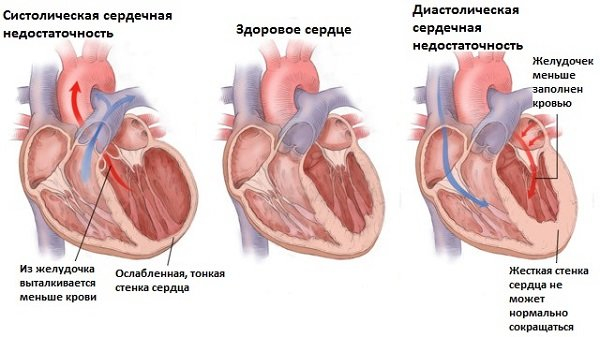 Что будет, если не лечить бронхит Что будет, если не лечить бронхит