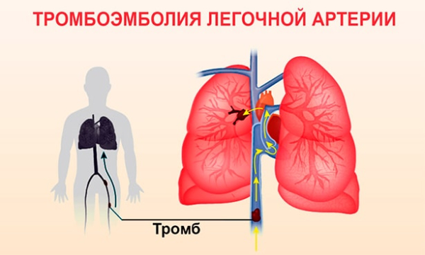 Что такое тромбофилия и в чем опасность патологии?