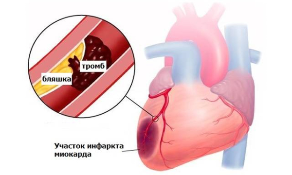 Что такое тромбофилия и в чем опасность патологии?