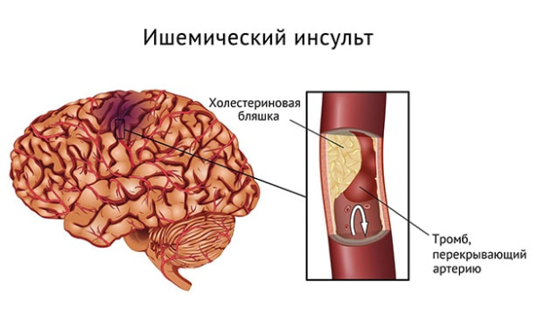 Что такое тромбофилия и в чем опасность патологии?