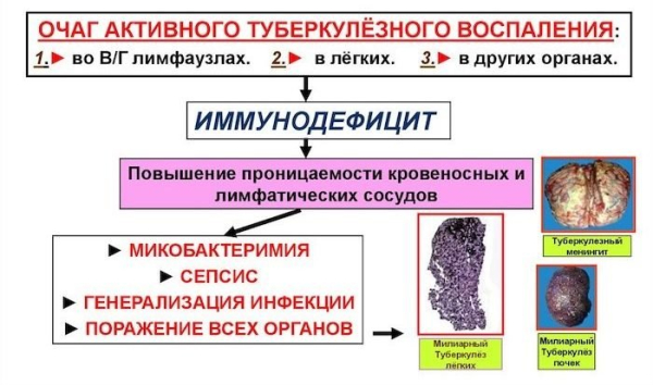 Симптомы, лечение и диагностика диссеминированного туберкулеза легких